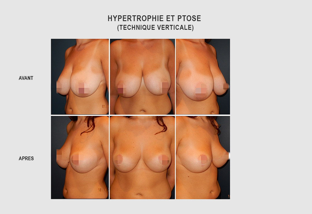 hypertrophie-ptose-002